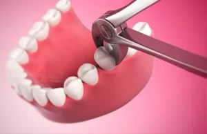 Удаление зубов (хирургическая стоматология)
