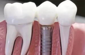 ​Имплантация зубов