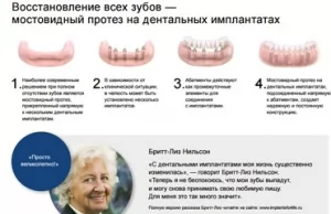 Восстановление всех зубов - системы имплантатов Astra Tech
