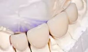 Классификация стоматологической керамики