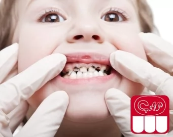 Почему у ребенка плохие зубы: главные причины и что можно сделать