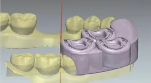 3D-моделирование и 3D-визуализация в ортопедической стоматологии