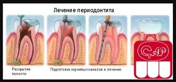 Лечение хронического периодонтита постоянных зубов со сформированными и несформированными корнями