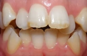 Что такое скученность зубов и как ее лечить