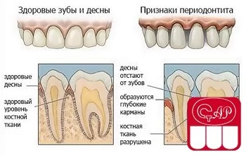Лечение острого токсического и травматического периодонтита постоянных зубов