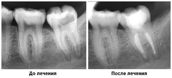 Лечение хронического периодонтита постоянных зубов с несформированными корнями thumbnail