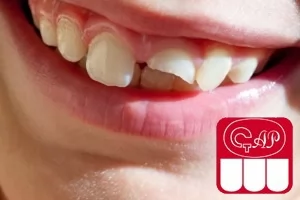 Травматические повреждения зубов у детей
