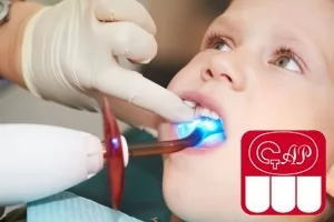 Способы обтурации каналов детских зубов