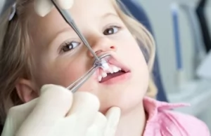 Как производится удаление молочного зуба с сохранёнными корнями