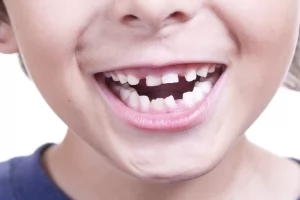 Что делать, если у ребенка кривые зубы