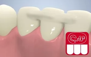 Шинирование зубов при лечении заболеваний пародонта
