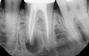 Особенности протекания периодонтита постоянных зубов