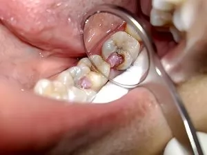 Лечение временных зубов в условиях общего обезболивания