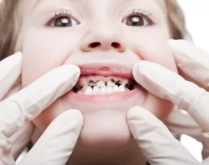 Почему у ребенка плохие зубы: главные причины и что можно сделать