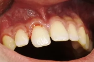 Повреждение тканей пародонта. Лечение травм постоянных зубов у детей