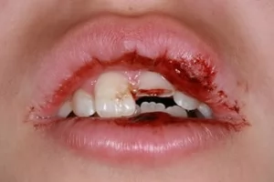 Лечение травм временных зубов у детей