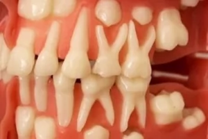 Особенности строения корневых каналов детских зубов