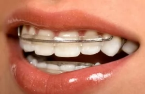 Пластины на зубы детям: показания, стоимость