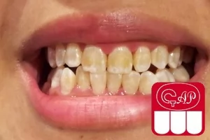 Что такое нарушение прорезывания зубов?