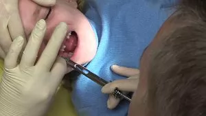 Лечение постоянных зубов в условиях общего обезболивания