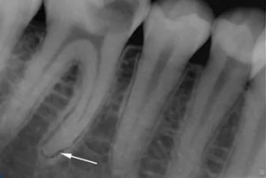 Хронический гранулирующий периодонтит молочных зубов
