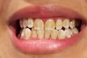 Что делать, если у ребенка гнилые зубы