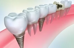 Имплантация зубов или протезирование – что лучше