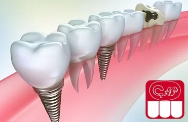 Имплантация зубов или протезирование – что лучше