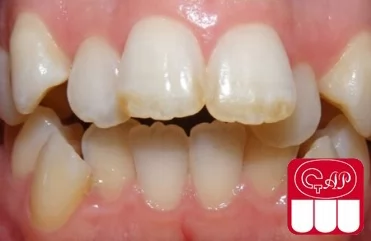 Что такое скученность зубов и как ее лечить