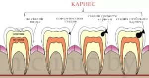 Как проявляется кариес временных зубов в зависимости от этапа формирования зуба