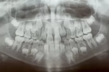 Рентгенологические стадии развития корня зуба и периодонта