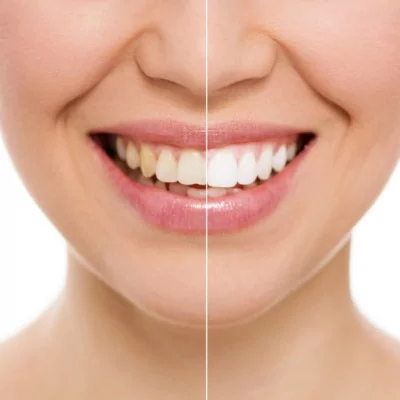 Виды зубных протезов для восстановления размера и формы зубов