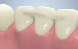 Шинирование зубов при лечении заболеваний пародонта