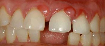 Лечение гранулирующего периодонтита молочных зубов thumbnail