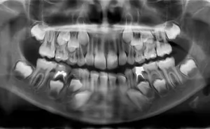 Рентгенологические стадии развития корня зуба и периодонта
