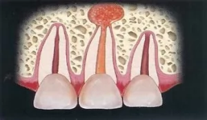 Лечение острого и хронического периодонтита временных зубов