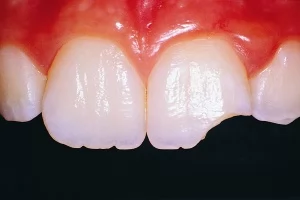 Повреждение твердых тканей зуба и пульпы. Лечение травм постоянных зубов у детей