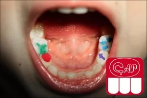 Медикаменты для обработки зубных каналов у детей