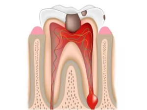 Лечение острого инфекционного периодонтита постоянных зубов