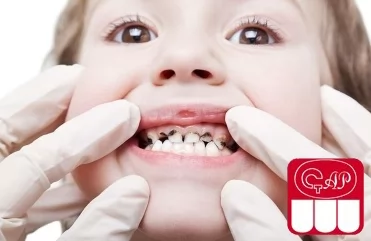 Почему у детей чернеют молочные зубы